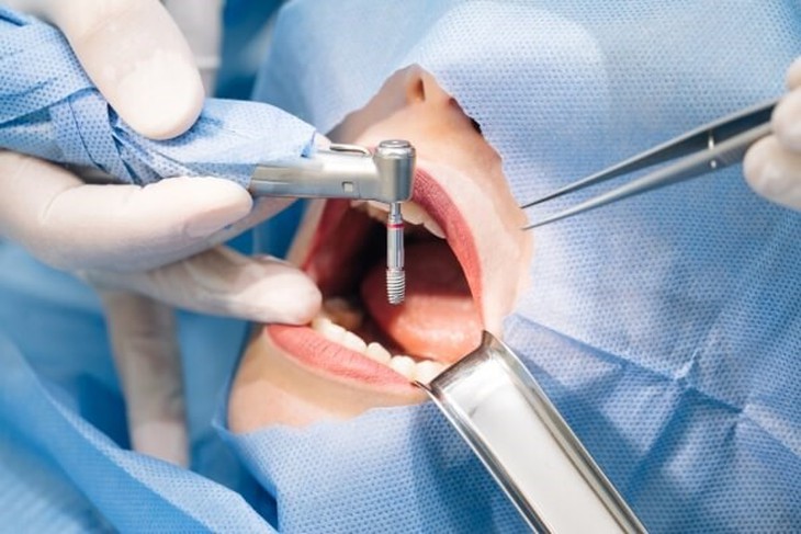 Cấy ghép Implant có đau không? Những điều cần biết về cảm giác đau- Ảnh 2.
