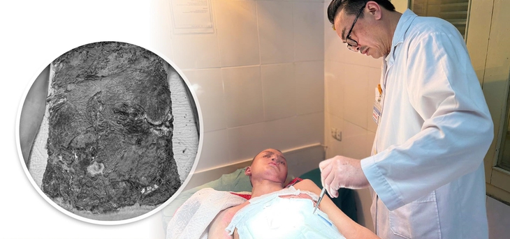 Nhiễm trùng nặng do điều trị bỏng bằng thuốc nam- Ảnh 1.