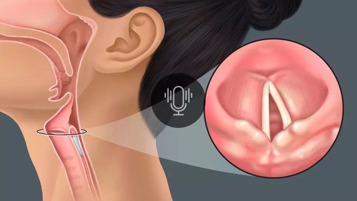 Chế độ ăn cho bệnh nhân liệt cơ mở thanh quản- Ảnh 1.