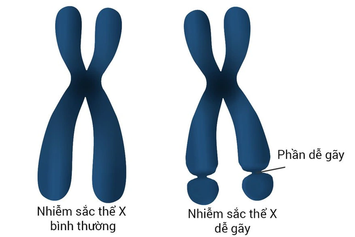 Hội chứng Fragile X – Nguyên nhân di truyền phổ biến gây thiểu năng trí tuệ ở trẻ- Ảnh 2.