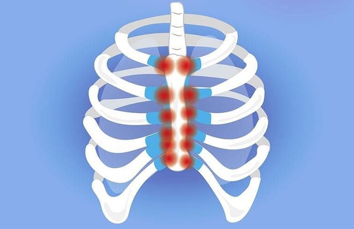 Vì sao vôi hóa sụn sườn dễ bị nhầm với bệnh tim?- Ảnh 2.