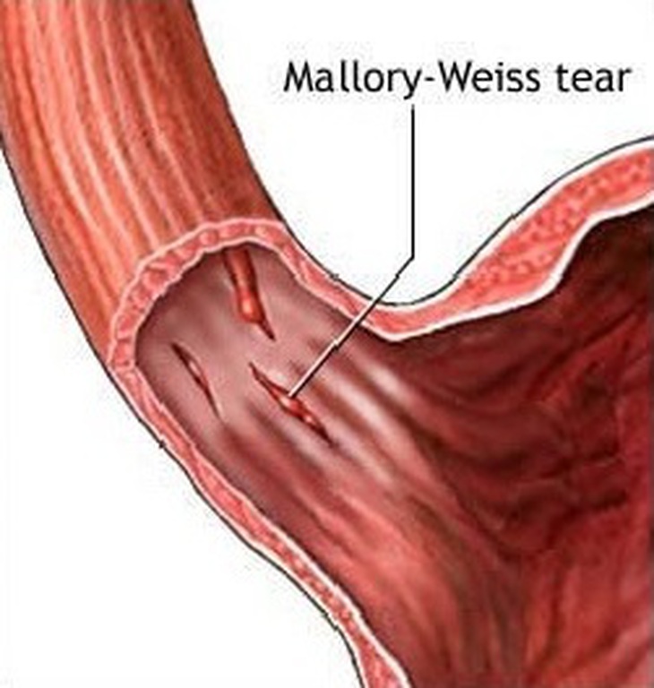 Chế độ ăn khi bị hội chứng Mallory Weiss- Ảnh 1.