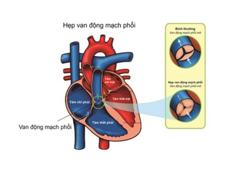 Câu hỏi thường gặp liên quan đến bệnh hẹp động mạch phổi- Ảnh 1.