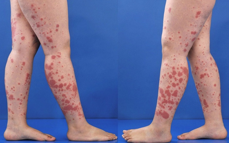 Viêm mao mạch dị ứng: Nguyên nhân, triệu chứng, cách điều trị và phòng ngừa