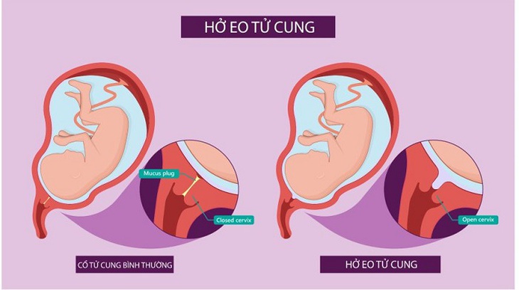 Câu hỏi thường gặp liên quan đến bệnh hở eo tử cung- Ảnh 1.