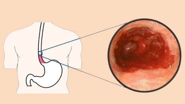 Loét thực quản: Triệu chứng, biến chứng nguy hiểm và điều trị