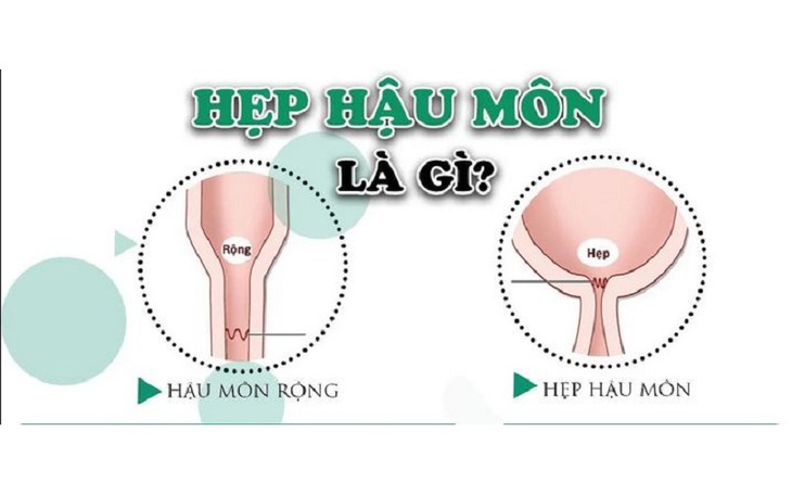 Bác sĩ ‘trả lại’ hậu môn về đúng vị trí cho bé 3 tuổi- Ảnh 3.