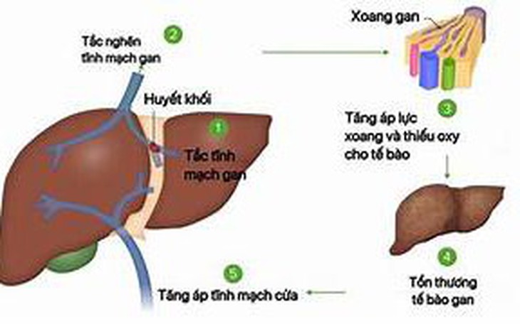 Các thuốc điều trị Hội chứng Budd-Chiari