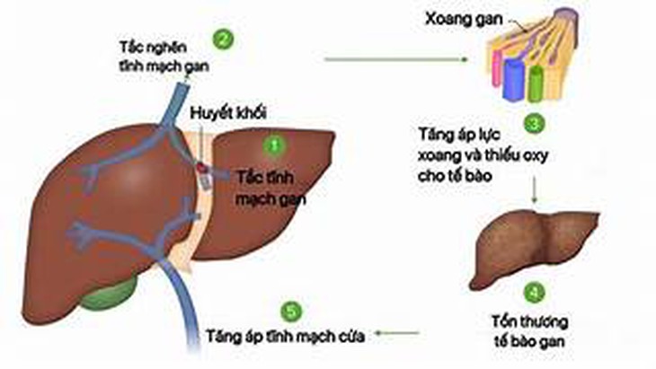 Các thuốc điều trị Hội chứng Budd-Chiari- Ảnh 1.