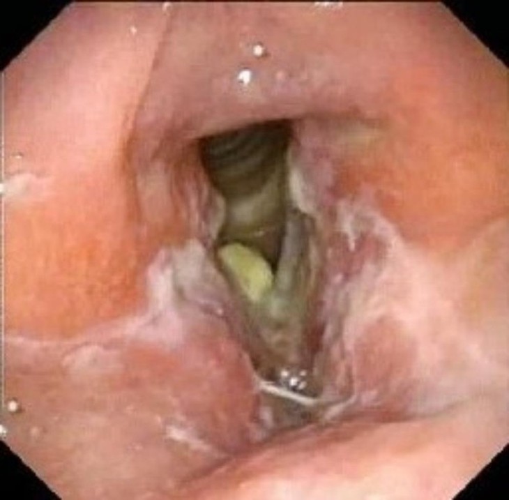 Laryngeal Tuberculosis: Current Patterns of Presentation and Management |  Indian Journal of Otolaryngology and Head & Neck Surgery