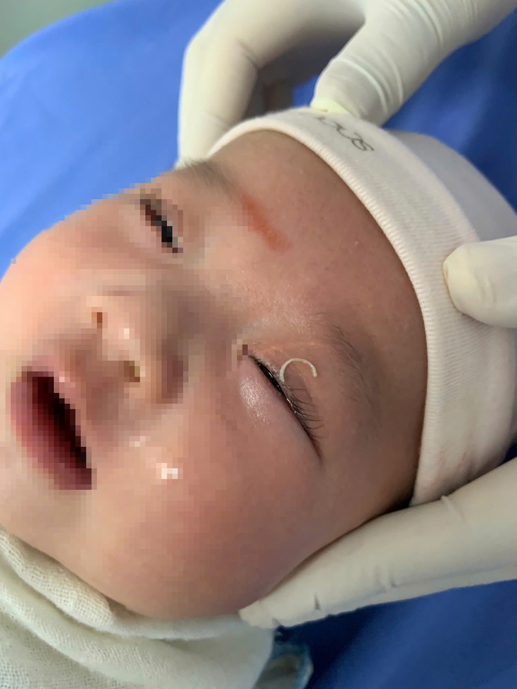 Hy hữu: Mẹ cắt móng tay khiến dị vật rơi vào mắt con 2 tháng tuổi- Ảnh 1.