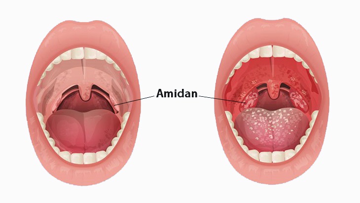 Viêm Amidan bao lâu thì khỏi? Viêm amidan có tự khỏi không