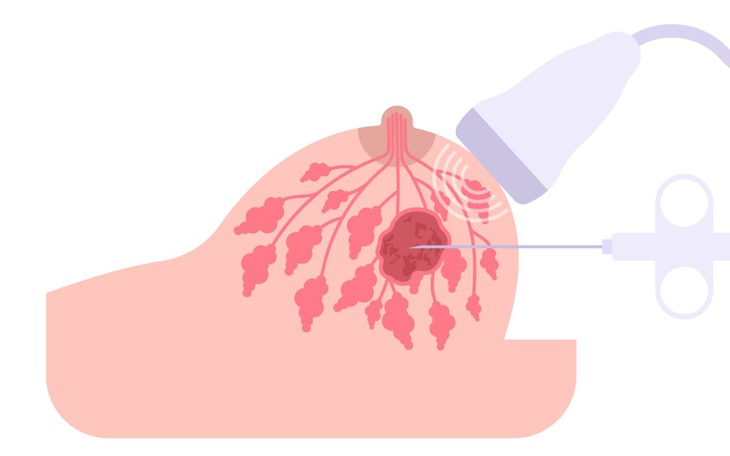 Sarcoma mạch máu: Ung thư hiếm gặp nhưng nguy hiểm