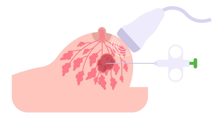 Sarcoma mạch máu: Ung thư hiếm gặp nhưng nguy hiểm- Ảnh 1. Sarcoma mạch máu: Ung thư hiếm gặp nhưng nguy hiểm- Ảnh 1.