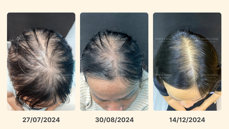Xu hướng điều trị rụng tóc mới năm 2025- Ảnh 2.