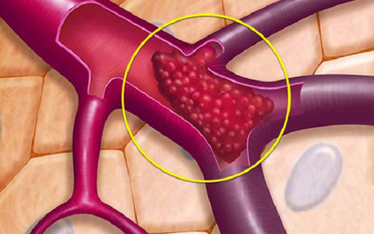 Câu hỏi thường gặp trong bệnh huyết khối
