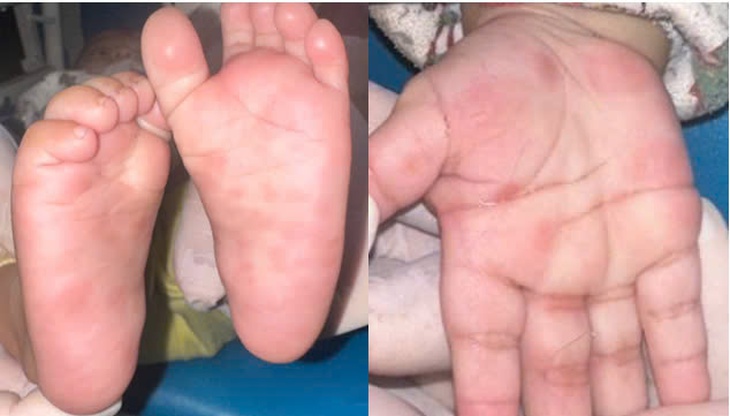 Nốt đỏ lòng bàn tay hé lộ căn bệnh nguy hiểm ở bé 4 tháng tuổi- Ảnh 1.
