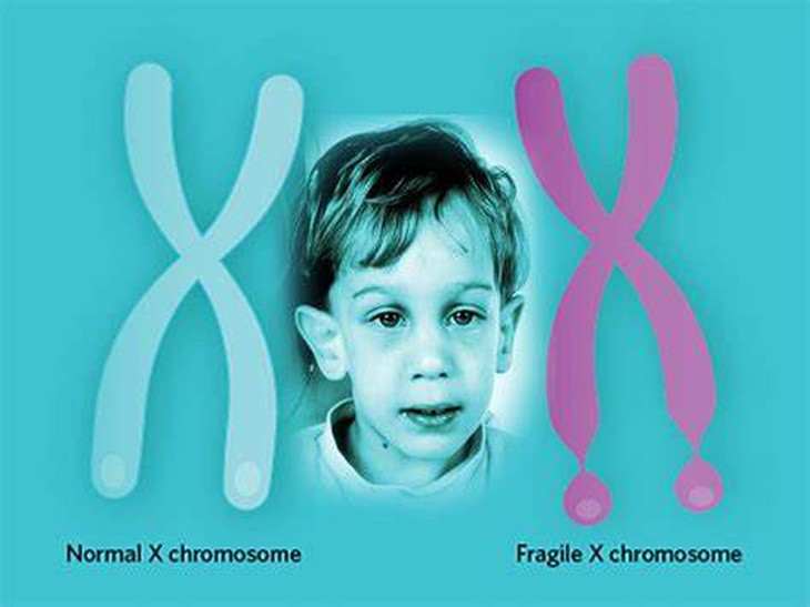 6 điều cần biết về hội chứng Fragile X- Ảnh 1.