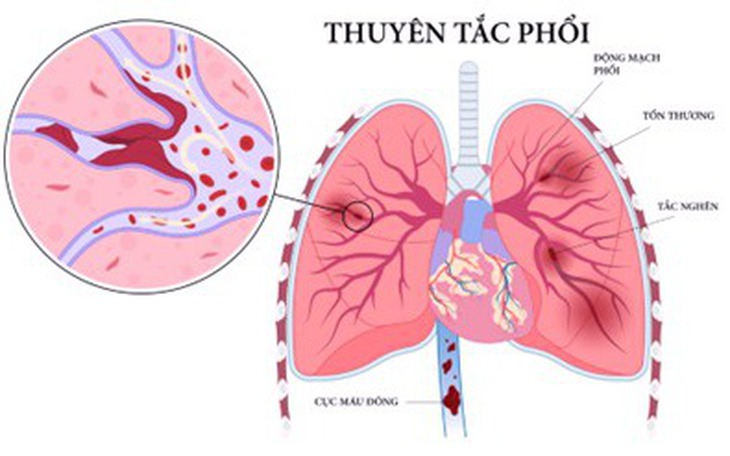 Thuyên tắc phổi: Nguyên nhân, triệu chứng, cách điều trị và phòng bệnh