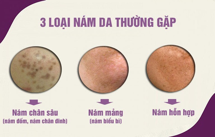Điều trị nám da bao lâu thì hết?- Ảnh 1.