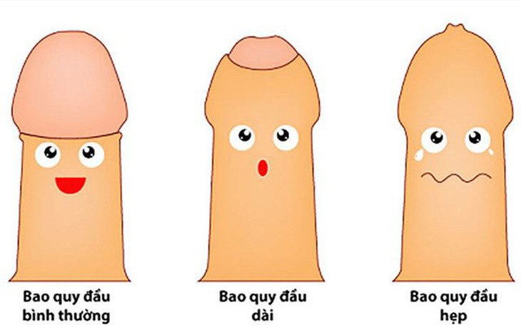 Câu hỏi thường gặp liên quan đến bệnh hẹp bao quy đầu