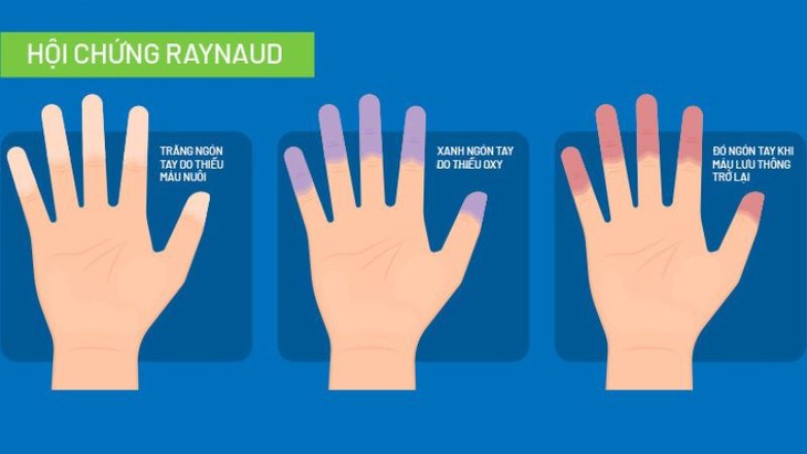 Bài tập nào tốt cho người mắc Hội chứng Raynaud?- Ảnh 1. Bài tập nào tốt cho người mắc Hội chứng Raynaud?- Ảnh 1.