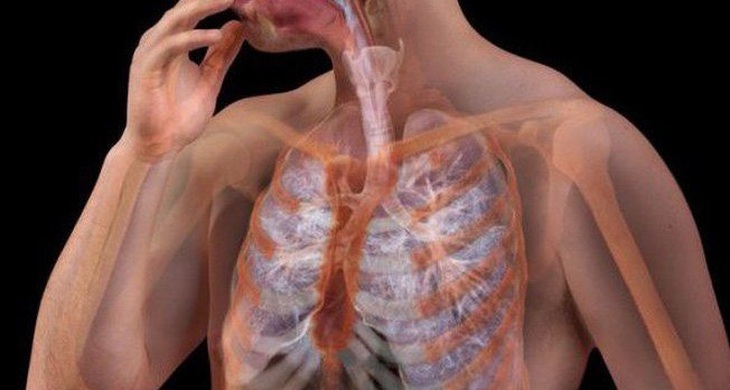 Giãn phế quản: Nguyên nhân, biểu hiện, cách điều trị và phòng bệnh- Ảnh 2.