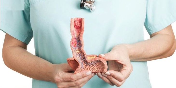 Câu hỏi thường gặp liên quan đến bệnh giãn tĩnh mạch thực quản- Ảnh 2.