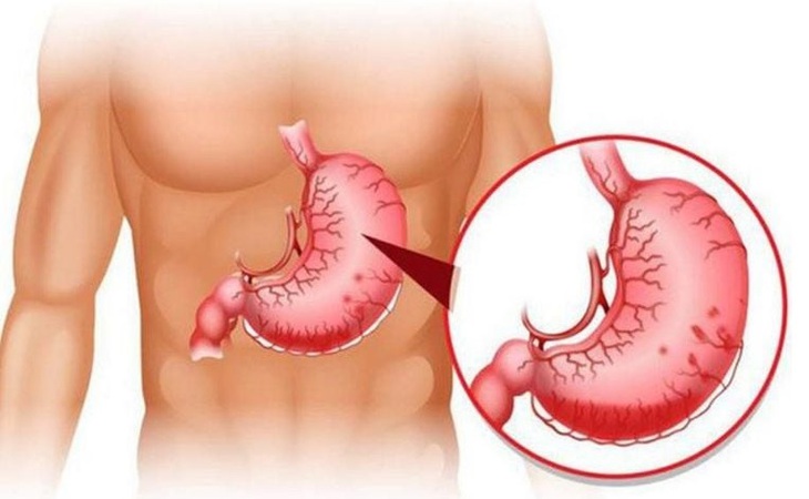 Câu hỏi thường gặp liên quan đến bệnh giãn tĩnh mạch thực quản- Ảnh 3.