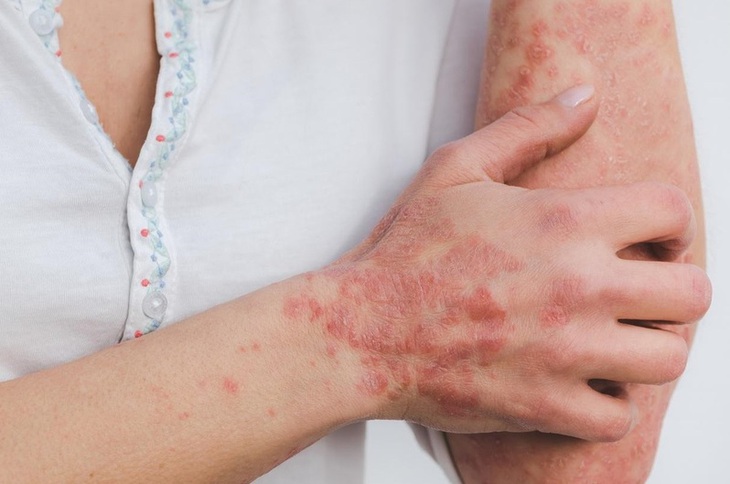 Câu hỏi thường gặp liên quan đến bệnh Lichen Nitidus- Ảnh 2.