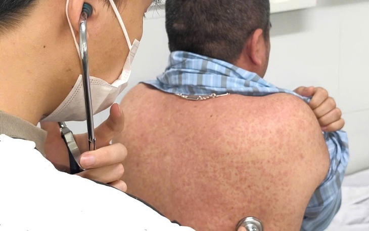 Nhiều người lớn mắc sởi biến chứng nặng