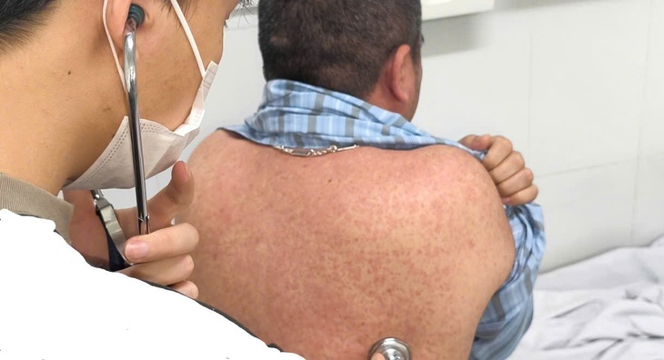 Nhiều người lớn mắc sởi biến chứng nặng- Ảnh 3.