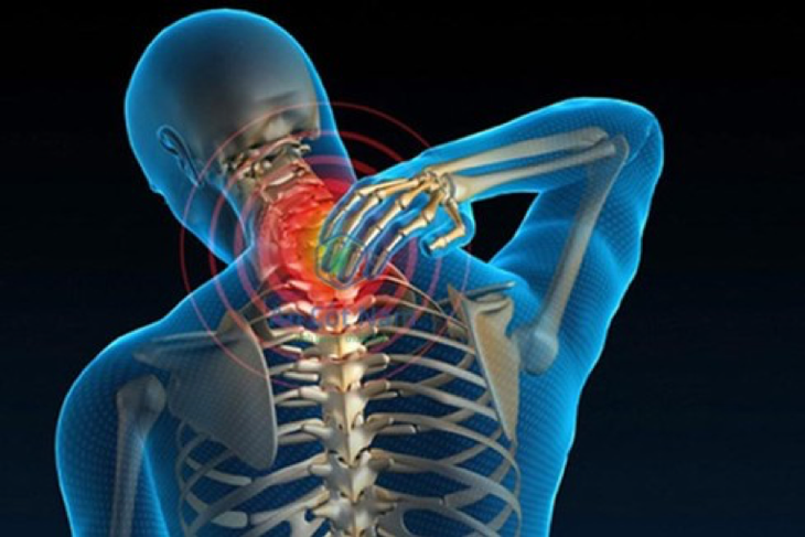 Các thuốc thường dùng trong điều trị thoái hóa cột sống cổ- Ảnh 1.