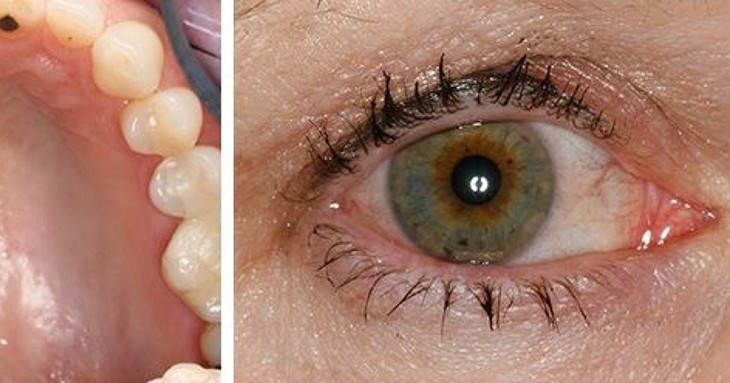 Câu hỏi thường gặp liên quan đến hội chứng Sjogren- Ảnh 1.