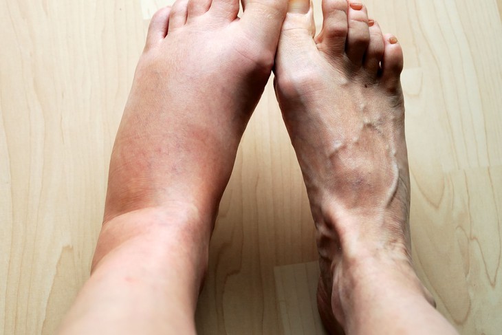 Dấu hiệu cảnh báo thận đang suy yếu- Ảnh 1.