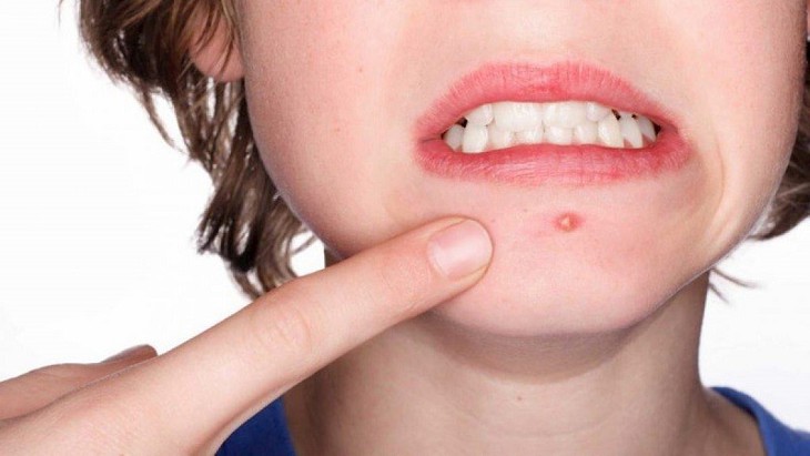 Điều trị mụn như thế nào là đúng cách và bao lâu sẽ có hiệu quả?- Ảnh 1.