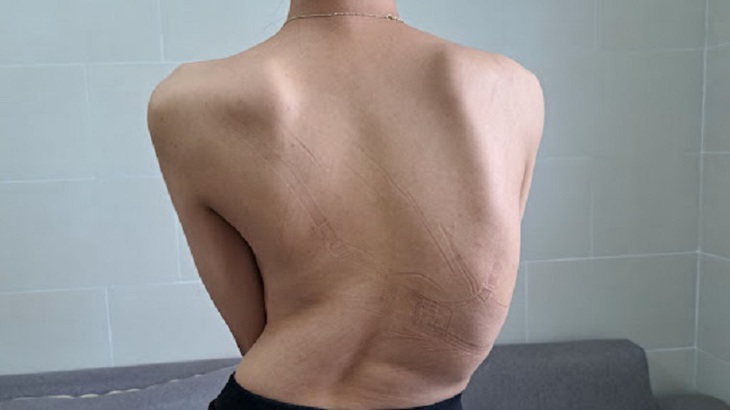 Vẹo cột sống: Nguyên nhân, triệu chứng, phòng ngừa và điều trị- Ảnh 2.
