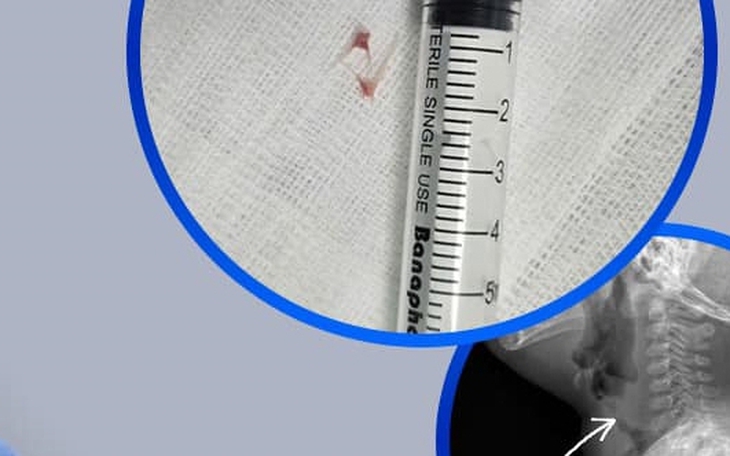 Hóc xương cá vào đường thở, bé 16 tháng tuổi nhập viện khẩn cấp