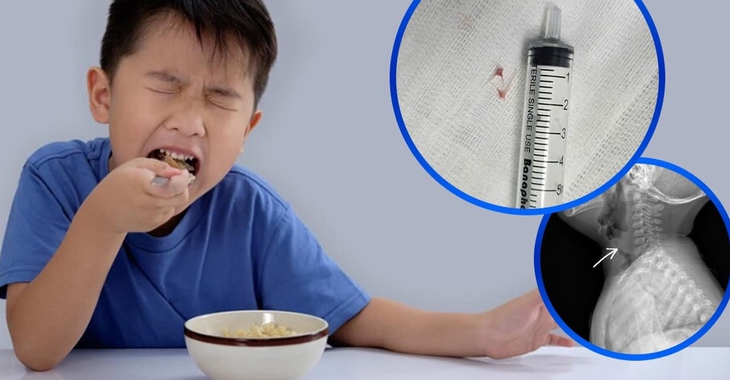 Hóc xương cá vào đường thở, bé 16 tháng tuổi nhập viện khẩn cấp- Ảnh 1.