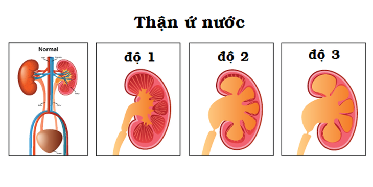 Bài tập cơ bản cho người bị thận ứ nước- Ảnh 1. Bài tập cơ bản cho người bị thận ứ nước- Ảnh 1.