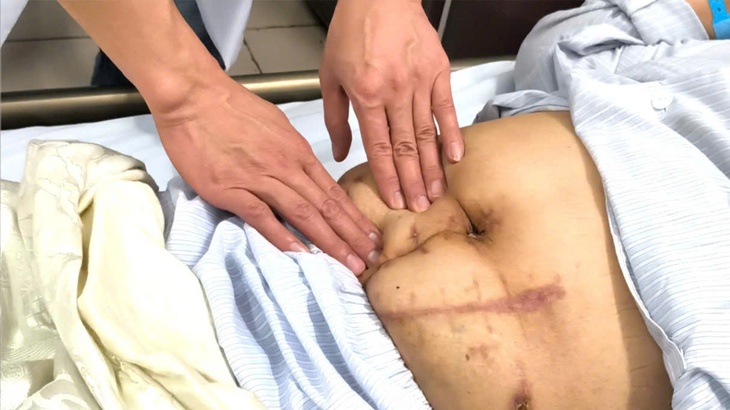 Phát hiện ung thư cực hiếm sau nhiều lần mổ tiết niệu- Ảnh 2.