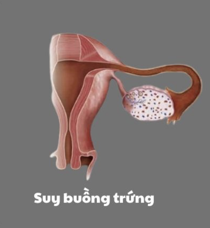 Các bài tập cho người bị suy buồng trứng- Ảnh 1.