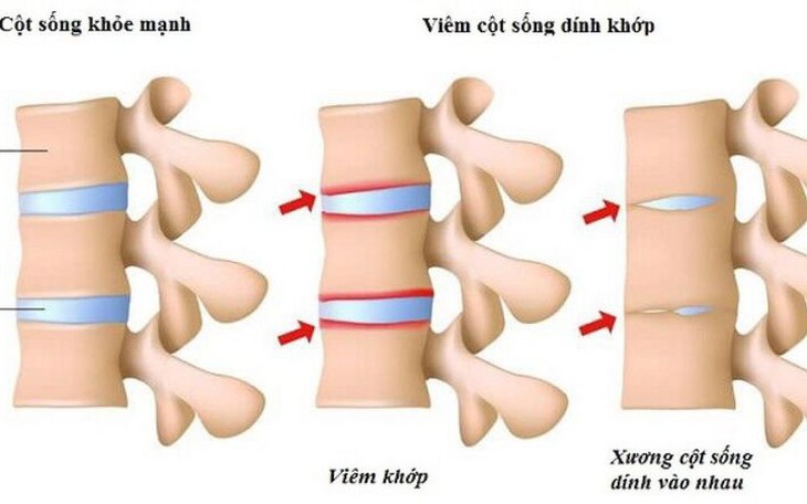 Viêm cột sống dính khớp: Nguyên nhân, triệu chứng, phòng ngừa và điều trị