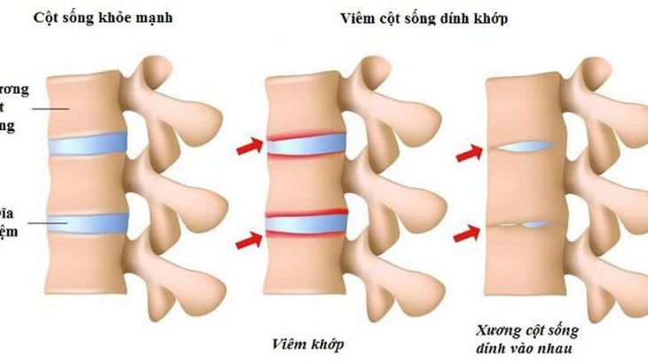 Viêm cột sống dính khớp: Nguyên nhân, triệu chứng, phòng ngừa và điều trị
- Ảnh 1. Viêm cột sống dính khớp: Nguyên nhân, triệu chứng, phòng ngừa và điều trị
- Ảnh 1.