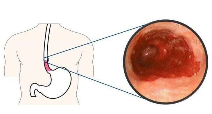 Bài tập cho người loét thực quản- Ảnh 1.