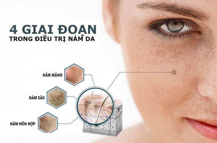Chữa nám da ở mức độ trung bình- Ảnh 1.