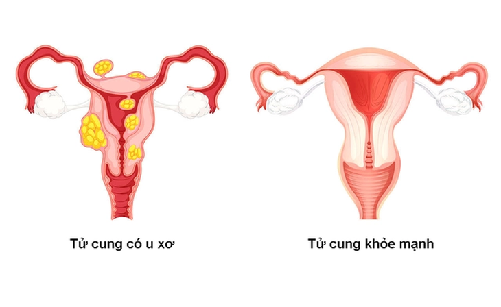 Thống kinh: Nguyên nhân, dấu hiệu và phương pháp điều trị- Ảnh 2.