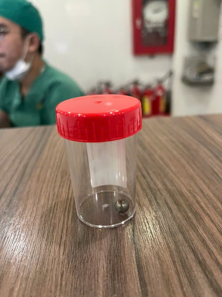 Nguy hiểm từ súng đồ chơi: Bé trai 5 tuổi vị viên bi bắn xuyên má, gãy xương mặt- Ảnh 1.