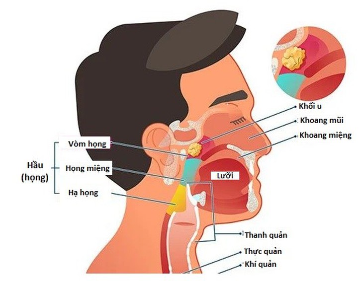 Ung thư đầu và cổ - Những điều nên biết- Ảnh 1.