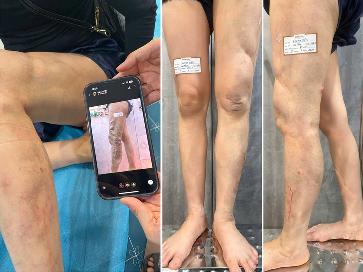 Điều trị dị dạng tĩnh mạch tại Phòng khám nội tĩnh mạch An Viên Hà Nội- Ảnh 2. Điều trị dị dạng tĩnh mạch tại Phòng khám nội tĩnh mạch An Viên Hà Nội- Ảnh 2.